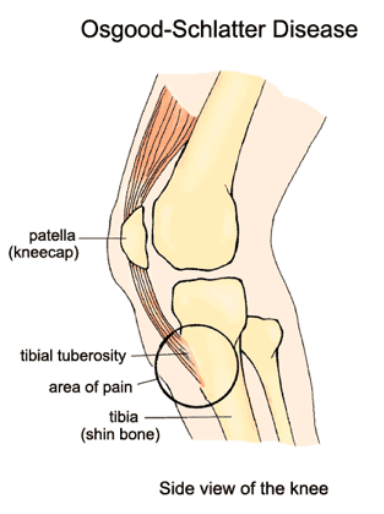 Osgood-Schlatter disease is caused by a loading overuse of the knee