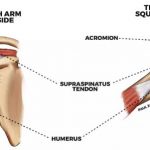 What is bursitis and treatment