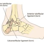 ankle sprain ligament injury