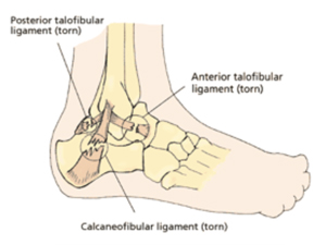 ankle sprain ligament injury