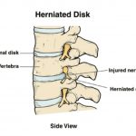 What is a herniated disk?