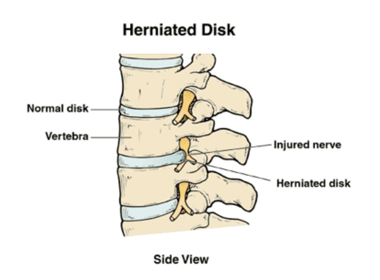 What is a herniated disk?
