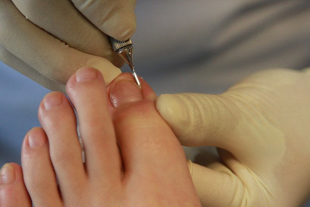 Debunking Myths About Ingrown Toenail Surgeries: Separating Fact from  Fiction - Elite Foot Care
